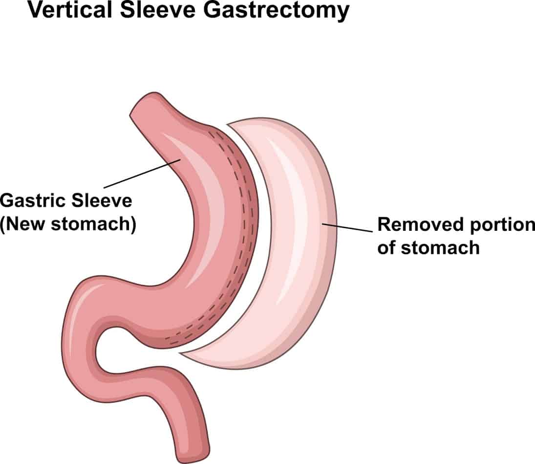 Weight Loss for Sleeve Gastrectomy