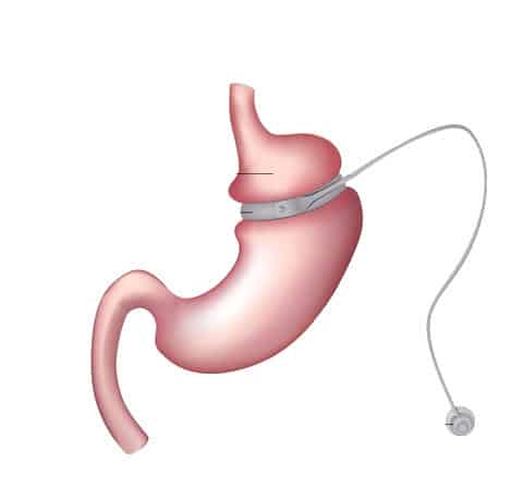 the-results-of-gastric-band-surgery